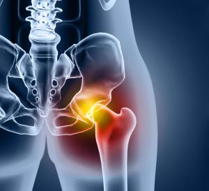 Hip Injury Car Accident Lawyer